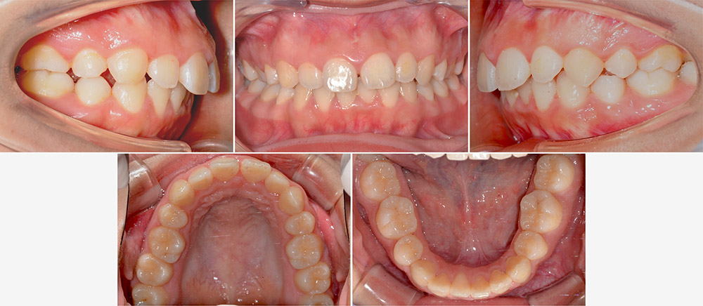 台中患者在二次矯正前各角度的牙齒咬合近照，有暴牙、嘴凸、笑齦、門牙縫等問題