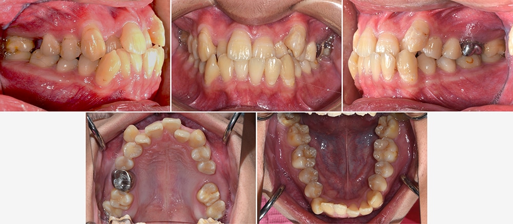 台中患者矯正前各角度的牙齒咬合近照，有齒列不整、牙齒擁擠、咬合不正、錯咬、戽斗等多項問題，且有一顆右上缺牙