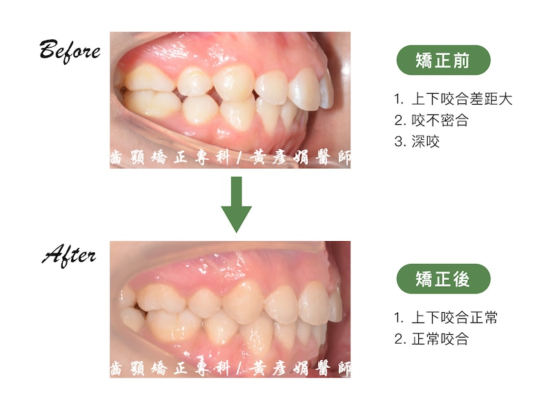 台中患者矯正前後的側面牙齒咬合比較：矯正前因暴牙導致上下咬合差距大、咬不密合並有深咬；矯正後上下咬合正常