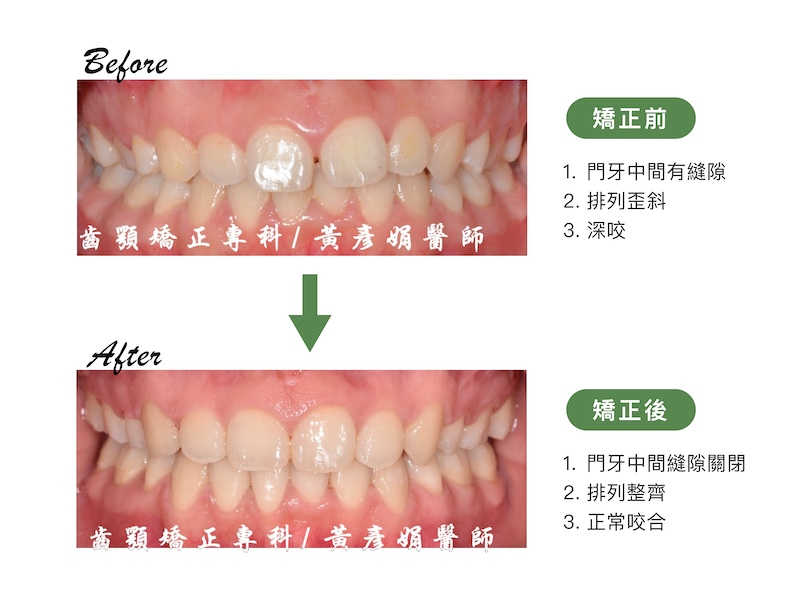 台中患者矯正前後的正面牙齒咬合比較：矯正前門牙中間有縫隙、排列歪斜並有深咬；矯正後門牙縫隙關閉，排列整齊恢復正常咬合