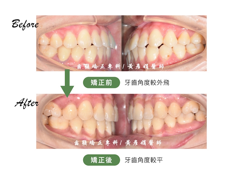 台中患者暴牙/戽斗矯正前後的牙齒咬合比較：矯正前牙齒角度較外飛，矯正後牙齒角度較平