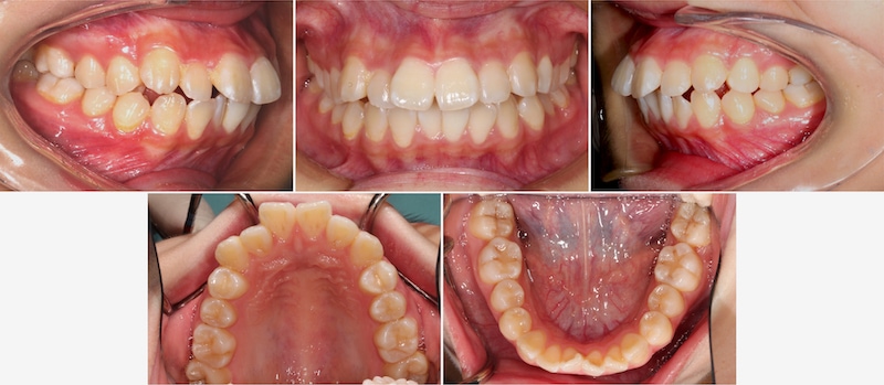 台中患者在暴牙矯正前各角度的牙齒咬合近照，有骨暴嘴凸、牙齒亂等問題