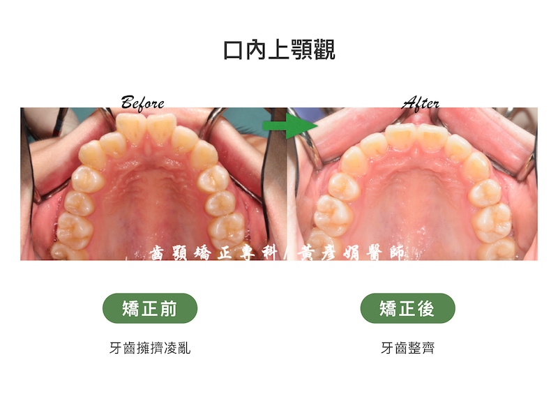 台中患者暴牙矯正前後的口內上顎觀比較：矯正前牙齒擁擠凌亂；矯正後牙齒整齊