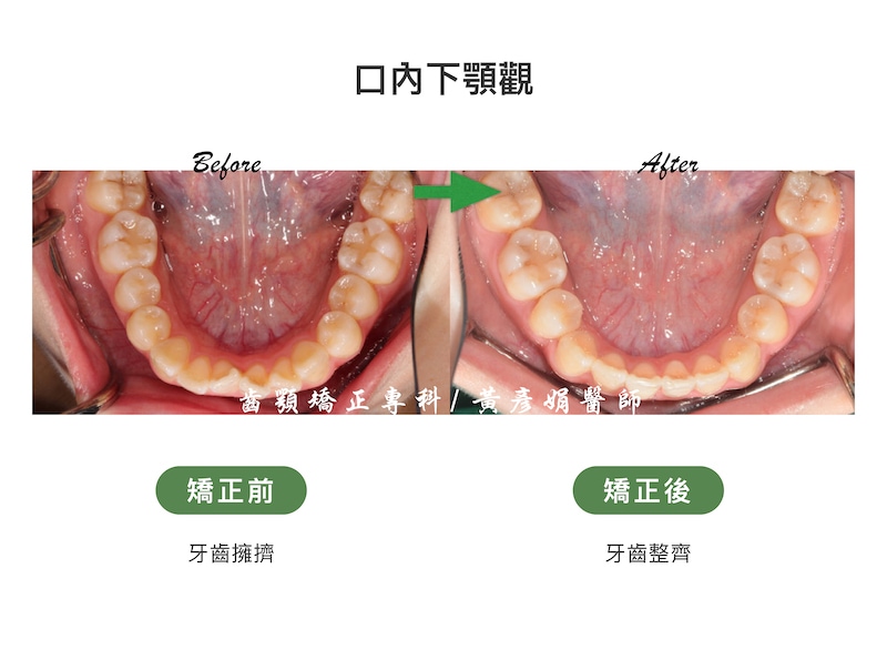 台中患者暴牙矯正前後的口內下顎觀比較：矯正前牙齒擁擠；矯正後牙齒整齊