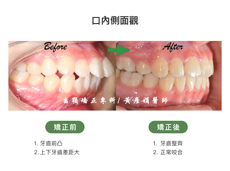 台中患者暴牙矯正前後的口內側面觀比較：矯正前牙齒前凸，上下牙齒差距大；矯正後牙齒整齊，恢復正常咬合