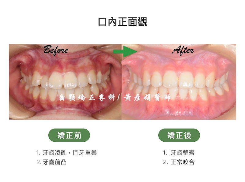 台中患者暴牙矯正前後的口內正面觀比較：矯正前牙齒凌亂、門牙重疊、牙齒前凸；矯正後牙齒整齊，恢復正常咬合