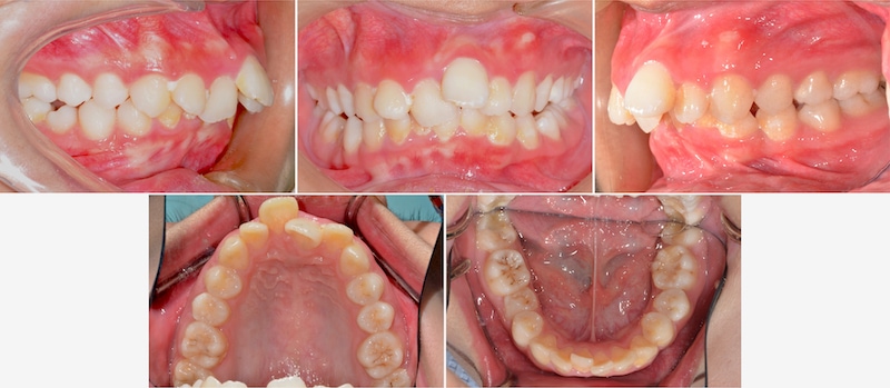 台中患者在矯正前各角度的牙齒咬合近照，有暴牙（骨暴）、牙齒亂、咬合不正、齒列擁擠、門牙重疊等問題