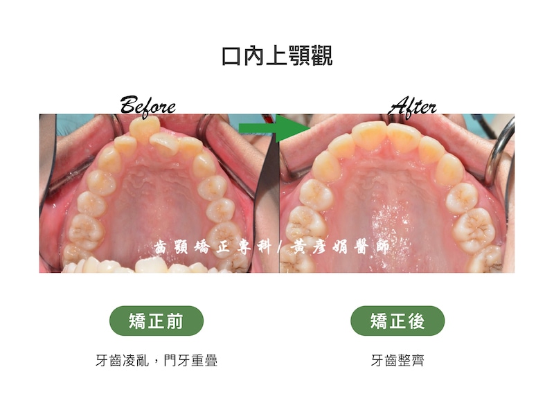 台中患者矯正前後的口內上顎觀比較：矯正前牙齒擁擠凌亂、門牙重疊；矯正後牙齒整齊