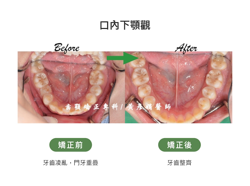 台中患者矯正前後的口內下顎觀比較：矯正前牙齒擁擠凌亂、門牙重疊；矯正後牙齒整齊