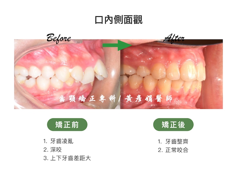 台中患者矯正前後的口內側面觀比較：矯正前骨暴導致牙齒上下差距大，並有牙齒凌亂、深咬；矯正後牙齒整齊，恢復正常咬合