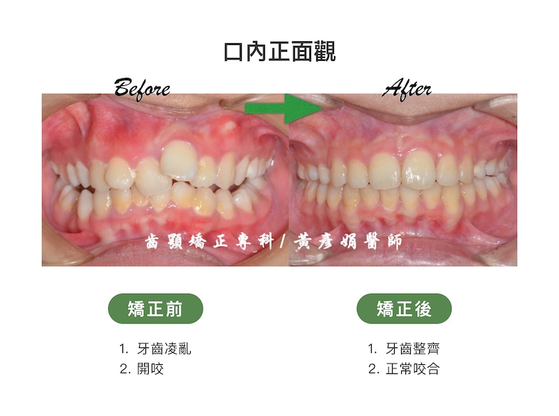 台中患者矯正前後的口內正面觀比較：矯正前牙齒凌亂並呈現開咬；矯正後牙齒整齊，恢復正常咬合