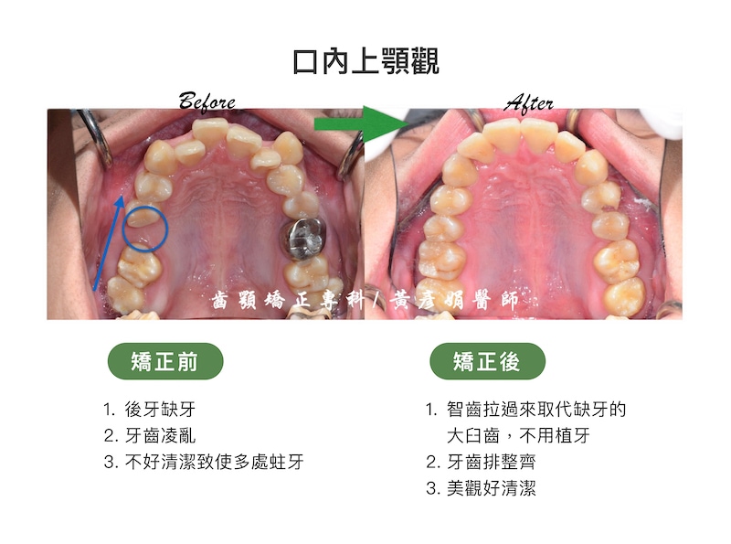 台中患者矯正前後的口內上顎觀比較：矯正前有後牙缺牙、牙齒凌亂等問題，不易清潔導致多處蛀牙；將智齒拉過來取代缺牙的大臼齒，矯正後避免未來植牙，牙齒排整齊後美觀也好清潔