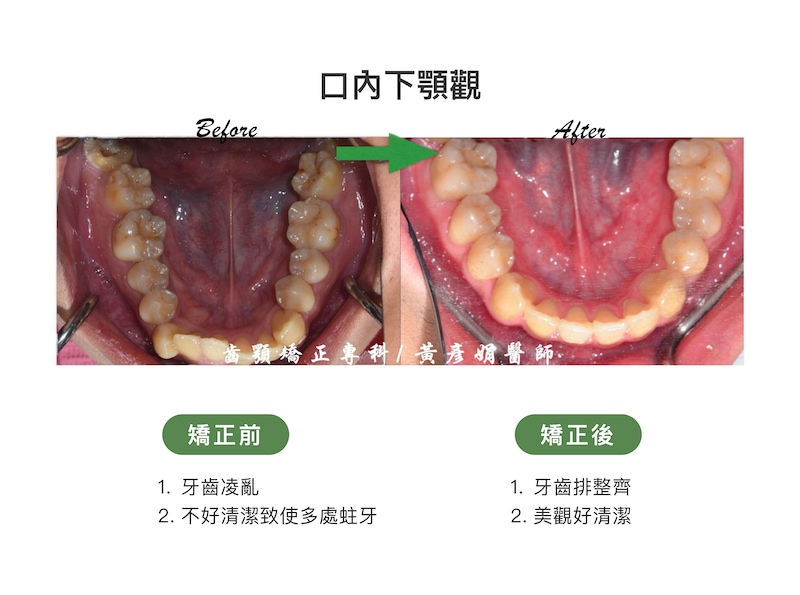 台中患者矯正前後的口內下顎觀比較：矯正前牙齒凌亂，不易清潔導致多處蛀牙；矯正後牙齒排整齊，美觀好清潔