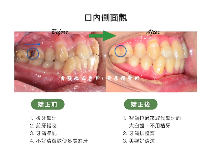 台中患者矯正前後的口內側面觀比較：矯正前有後牙缺牙、前牙錯咬、牙齒凌亂等問題，不易清潔導致多處蛀牙；將智齒拉過來取代缺牙的大臼齒，矯正後避免未來植牙，牙齒排整齊後美觀也好清潔