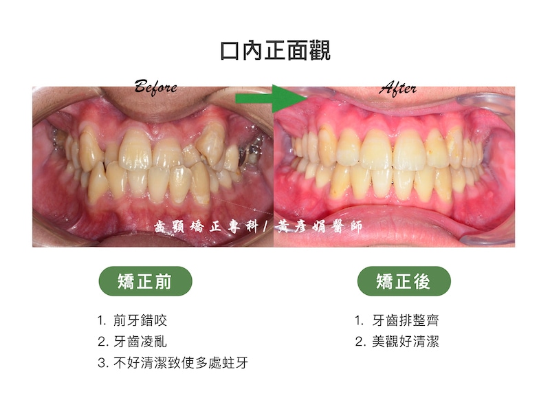 台中患者矯正前後的口內正面觀比較：矯正前前牙錯咬、牙齒凌亂，不易清潔導致多處蛀牙；矯正後牙齒排整齊，美觀好清潔